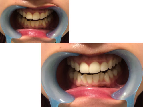 ホワイトニング無料